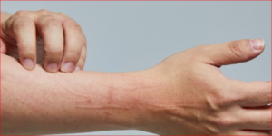 Early Diabetes Skin Symptoms: Itching, Dryness, and Acanthosis Nigricans Warning Signs